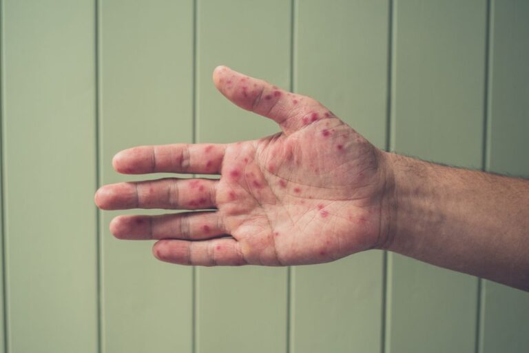 Sesa Confirma 12 Casos Acumulados de Sarampión en Querétaro