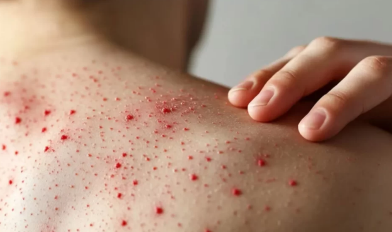 Sarampión Cae Tras 17 Millones De Vacunas